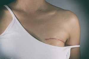 Breast cancer reconstruction cheshire